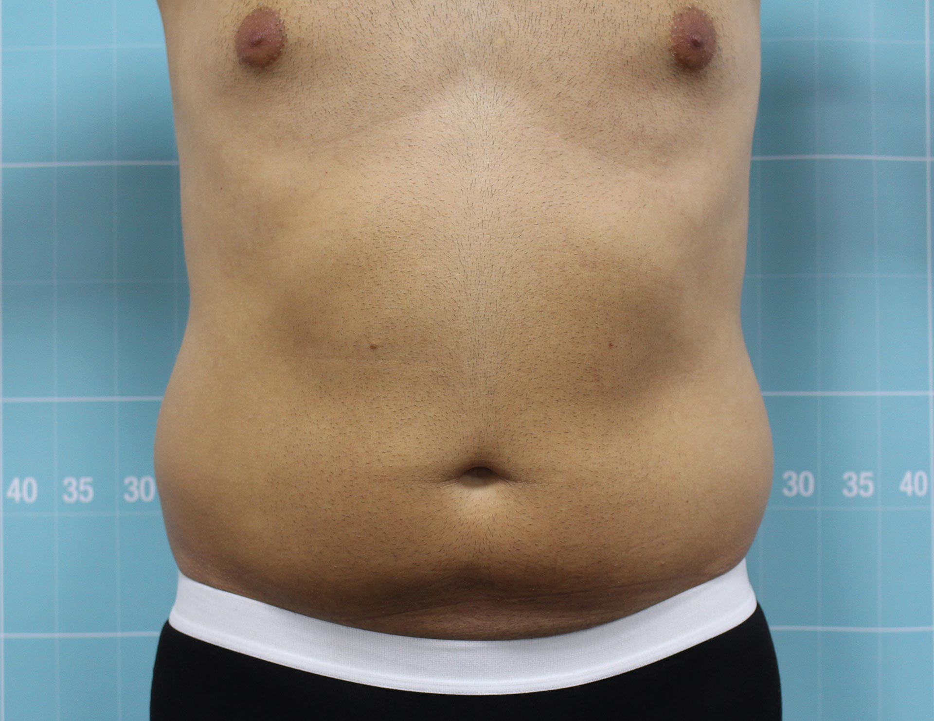 FAT FREEZING TREATMENT COST UK visual data 3